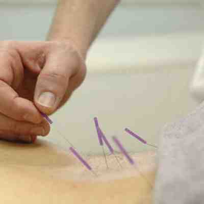 Acupuncture for back injuries