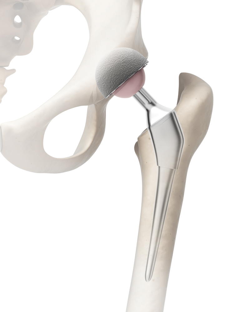 Chronic Pain After Hip Replacement