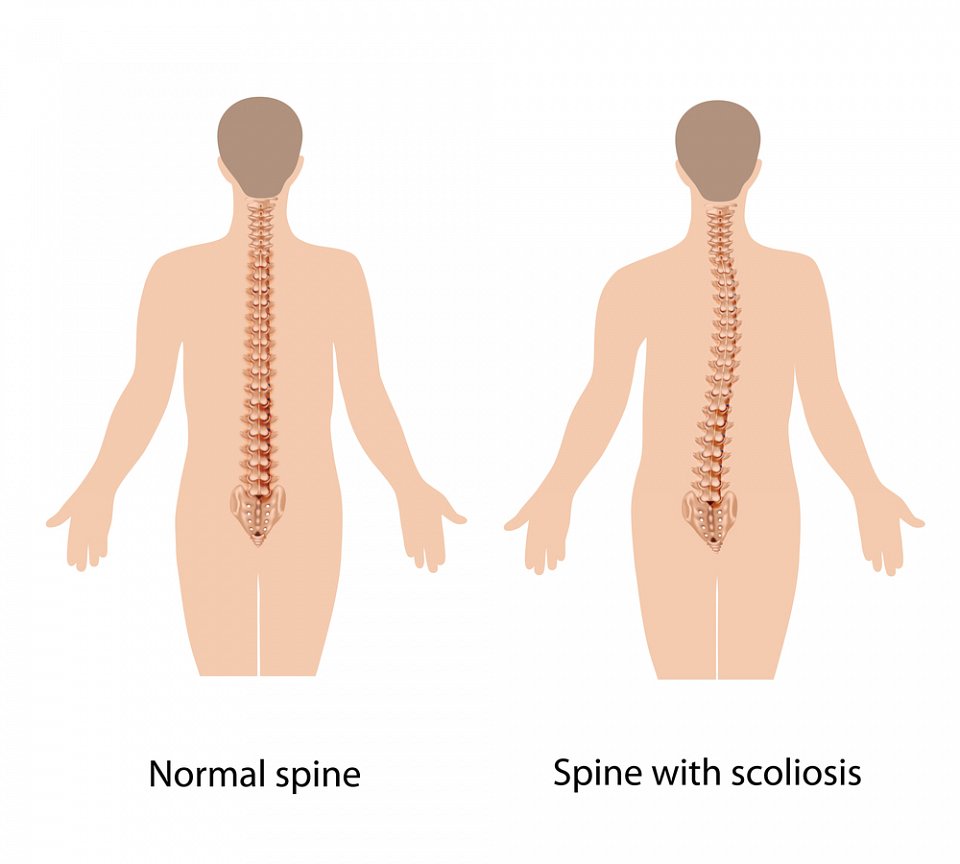 Mild Scoliosis