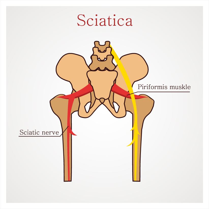 Piriformis Syndrome Explained