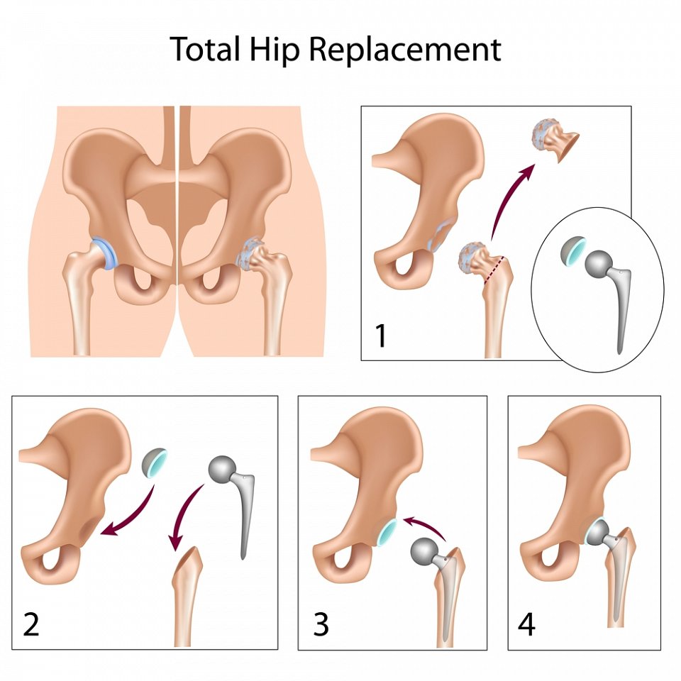 hip-surgery-exercises-for-recovery